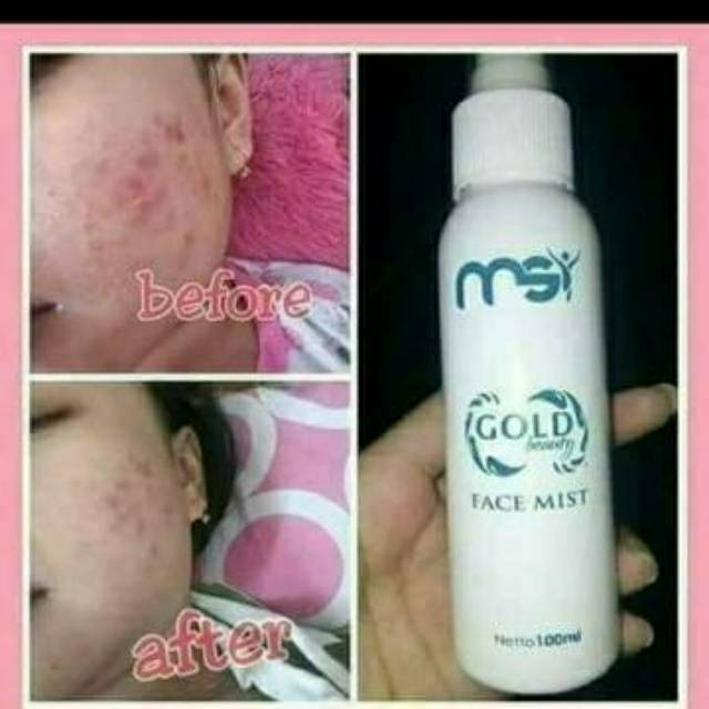 23++ Manfaat face mist msi untuk jerawat ideas