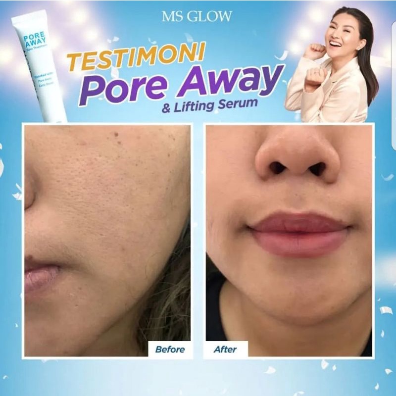 MS GLOW Pore away Treatment II Khusus Pori pori besar.