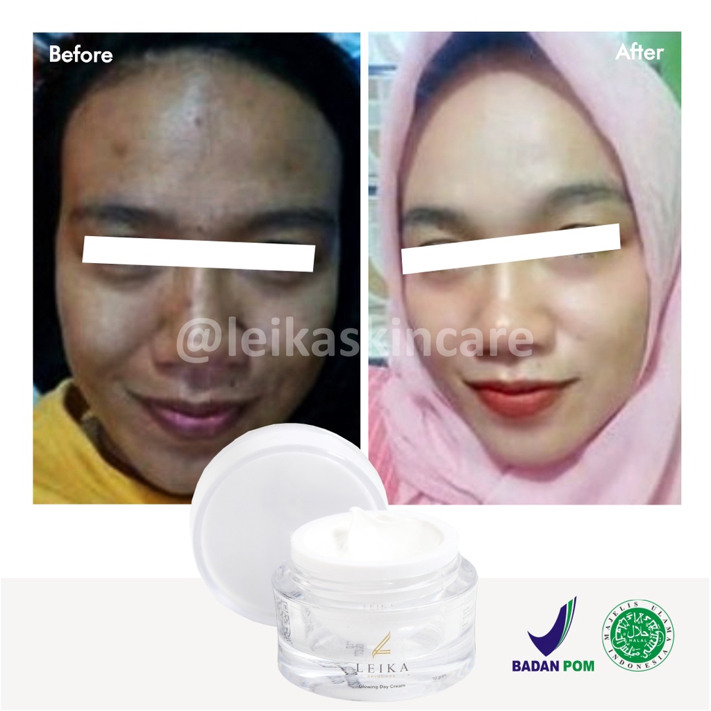 Obat Jerawat Paling Cepat dan Ampuh BPOM Obat untuk Kulit Wajah Berminyak Berjerawat Asli 100% dan Halal MUI Glowing Day Cream Leika Skincare 10gr Penghilang Jerawat Ampuh Aman Ori