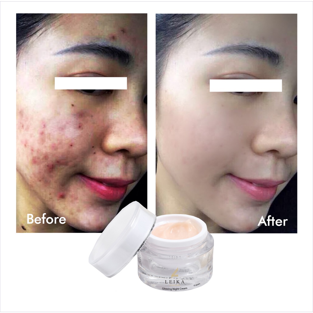 Cream Penghilang Jerawat Penghilang Bekas Jerawat Ampuh! Obat Jerawat dan Bekas Jerawat Obat Jerawat Paling Ampuh untuk Wanita Penghilang Jerawat dan Bekas Jerawat Glowing Night Cream Leika Skincare Resmi BPOM cream wajah berminyak dan berjerawat