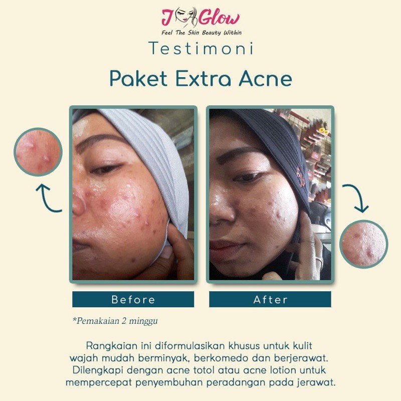 Jglow Skincare Jiglow J Glow Paket Extra Acne Sulfur Cream JNC 3 klinik farmasi dokter Skincare Khus