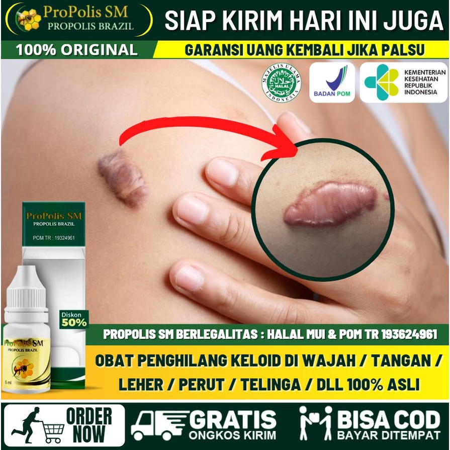 Salep Keloid di Wajah Tanpa Efek Samping 100% Alami, Menghilangkan Keloid Bekas Tahi Lalat di Wajah,