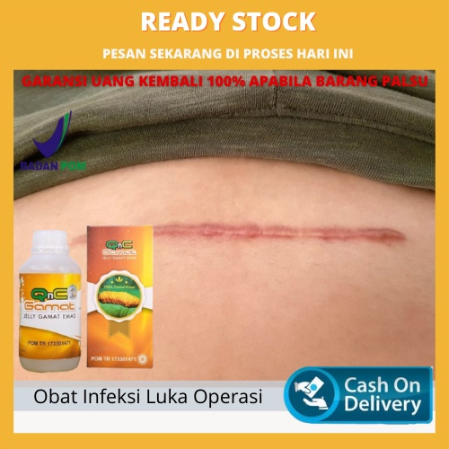 Obat Luka Operasi, Obat Pengering Luka, Obat Pengering Luka Operasi Sesar/Caesar, Obat Pasca Operasi