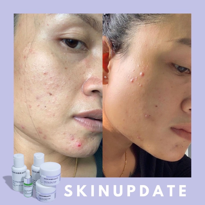 (ECER ACNE) OshinBeauty - Acne Series Oshin Beauty Skincare [Free Gift]-5