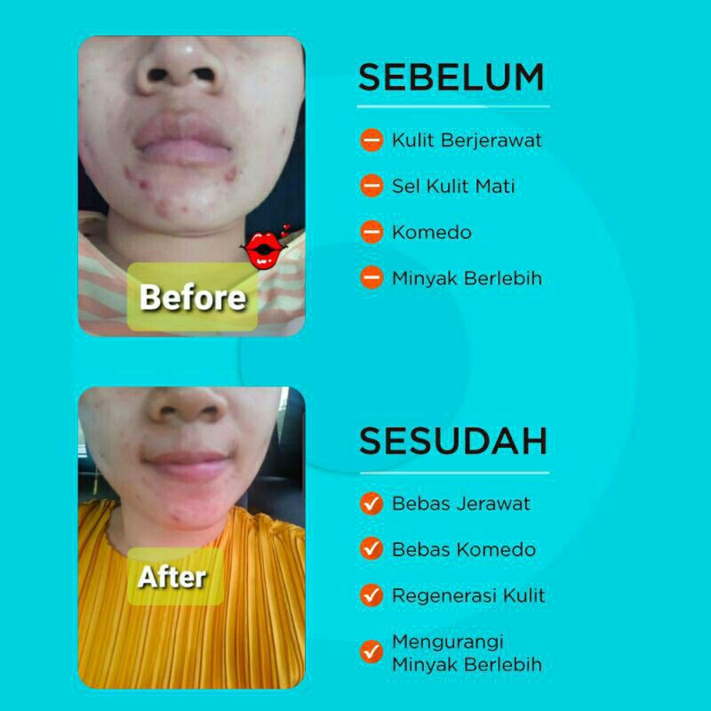 ERHA Acne Cleanser Beta Scrub Plus(ACSBP)