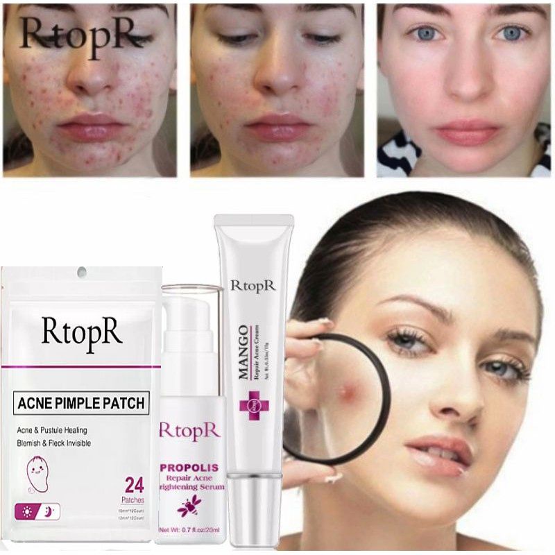 Rtopr acne series perawatan jerawat