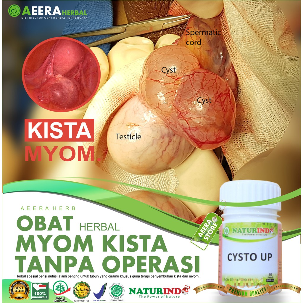 Jual Obat Kista Ovarium Myom Bartholin Kista Coklat Benjolan Di Rahim Vaginamiss V 4268