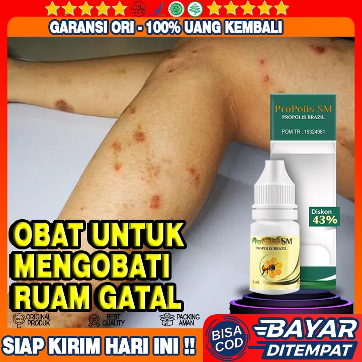 Obat Ruam Leher Bayi, Obat Oles Ruam Leher Bayi, Obat Penghilang Ruam Leher, Propolis SM 100% Aman