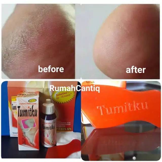TUMITKU MENGATASI KAKI KERING KASAR PECAH-PECAH KAPALAN SECARA INSTAN BPOM