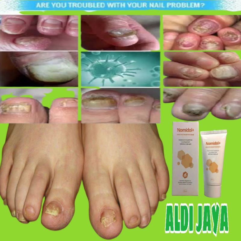 NOMIDOL OBAT JAMUR KUKU KAKI TANGAN 100% SEMBUH