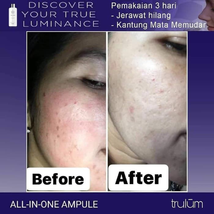 

Skincare Herbal Alami Ampuh Obati Bekas Jerawat Flek HItam & Keriput