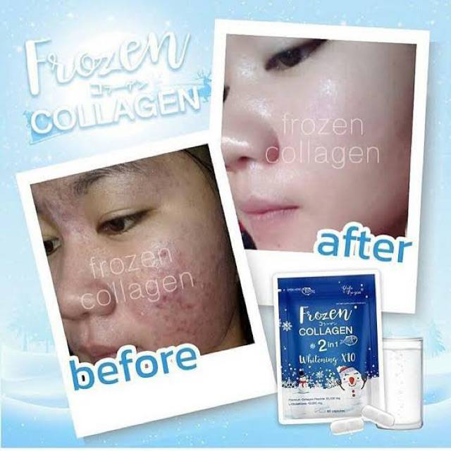 Frozen collagen - obat pemutih tubuh