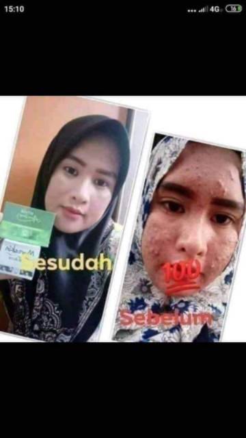 Moreskin Acne&amp; Ershali Acne Cream jerawat