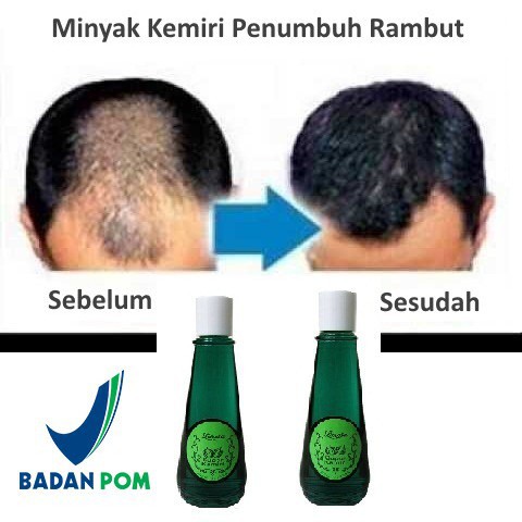 *MSTH* Larosa Minyak Kemiri Penyubur Rambut untuk Perawatan Rambut