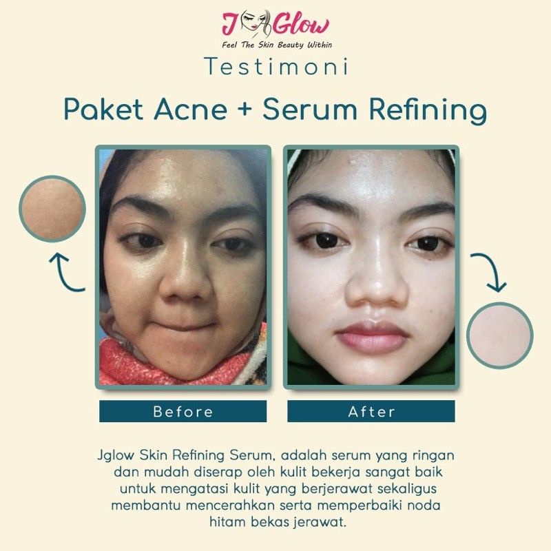 jglow skincare paket acne / j-glow skincare paket acne / j glow skincare paket acne / cream jglow