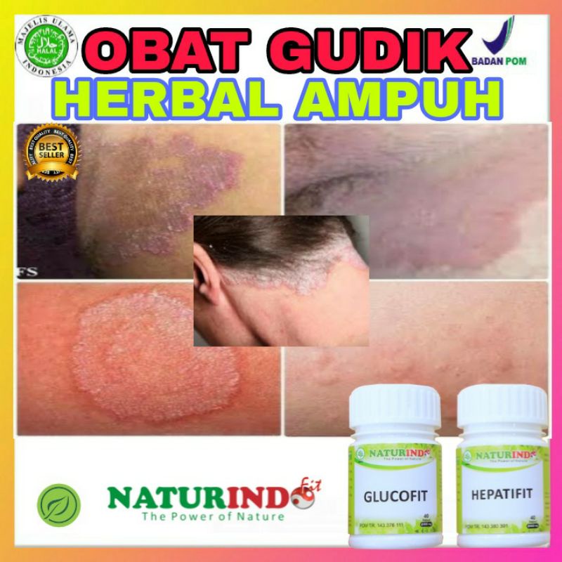 Jual Obat Gudik Menahun Scabies Jamur Kulit Herbal Paling Ampuh Naturindo Shopee Indonesia