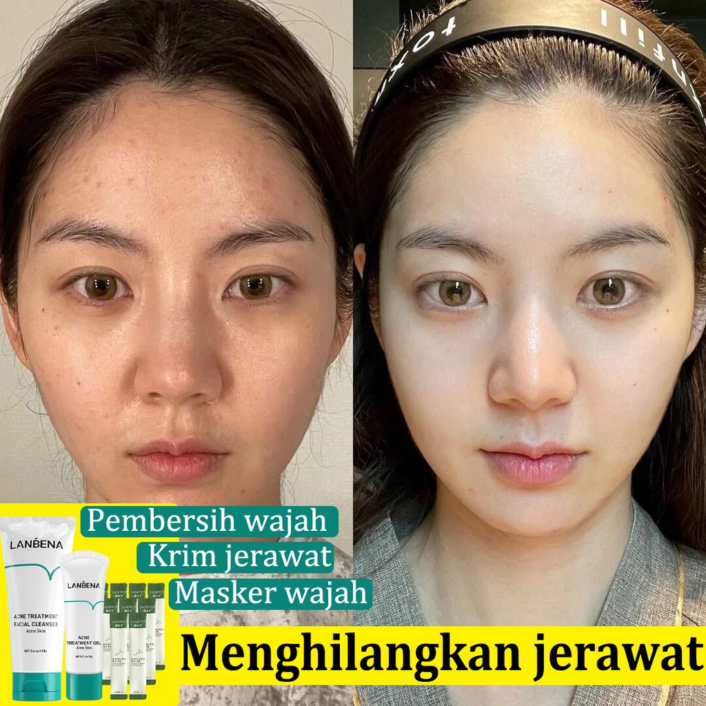 cream jerawat krim jerawat alat jerawat cream untuk jerawat cream jerawat ampuh krim malam jerawat Anti Jerawat penghilang jerawat salep jerawat serum penghilang jerawat pembersih jerawat acnes gel jerawat