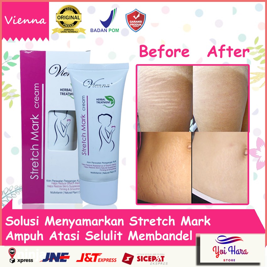 STRECHMARK CREAM | PENGHILANG STRECHMARK AMPUH PERMANEN BPOM | VIENNA STRETCH MARK CREAM | OBAT STRE