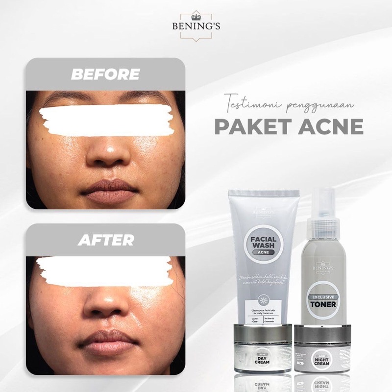 BENINGS SKINCARE DR OKY PRATAMA PAKET ACNE UNTUK MENGATASI JERAWAT DAN BERUNTUSAN ( BENINGS INDONESIA )-4