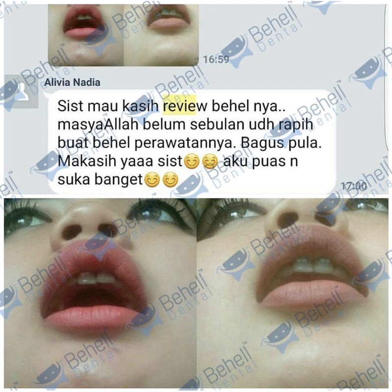 ORI BRACKET BEHEL PERMANEN ALFA CLEAR CERAMIC / BENING TRANSFARAN TRANSPARAN KERAMIC BEHELLDENTAL