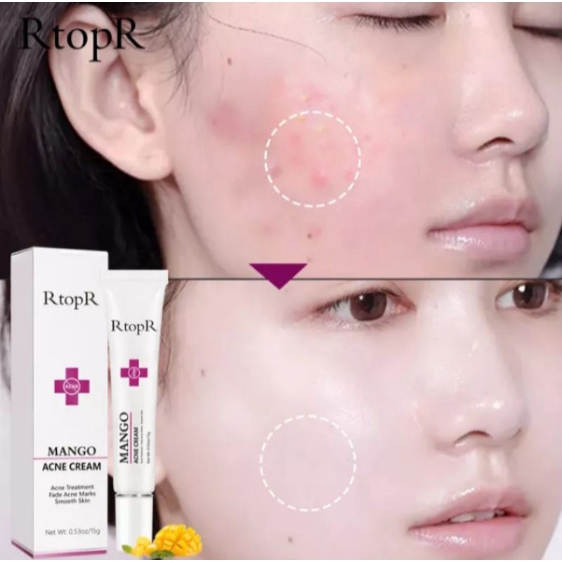 RtopR MANGO REMOVE ACNE CREAM | CREAM ANTI JERAWAT, DARK SPOT, PERBAIKAN PORI |