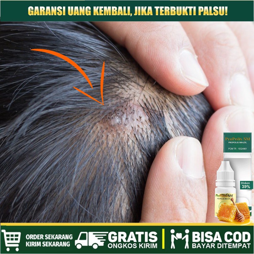 Obat Benjolan Bernanah Di Kepala Obat Jerawat Kulit Kepala Obat Tetes Benjolan Di Kepala Propolis Shopee Indonesia