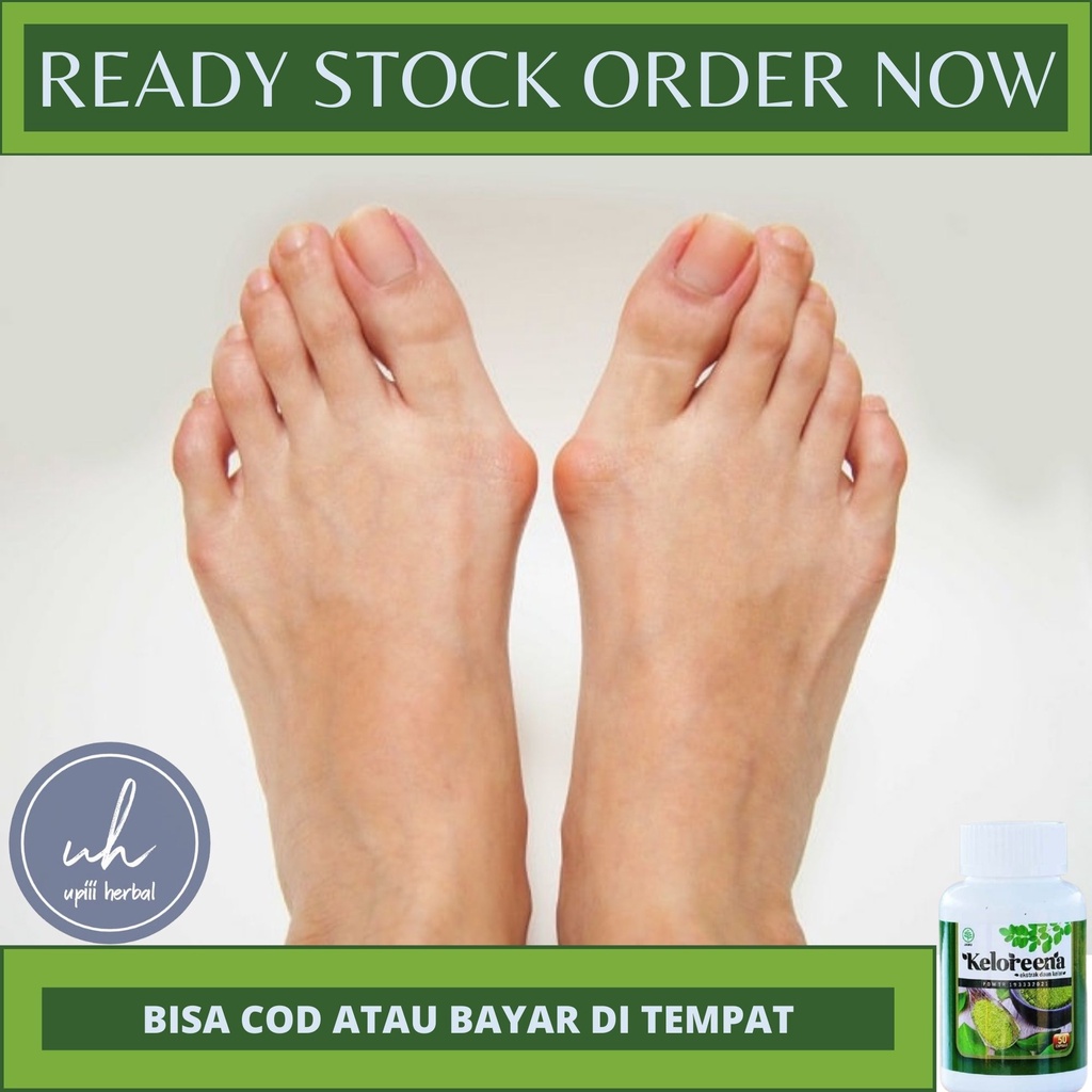 Obat Bunion, Obat Herbal Untuk Bunion, Obat Pengempis Bunion, Obat benjolan Di Jempol Kaki, Obat Pen