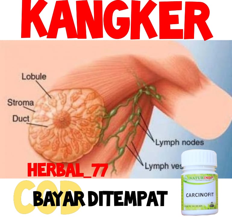 OBAT KANGKER SERVIK KANGKER KANDUNGAN MIOM KISTA KANKER DARAH KANGKER KULIT KANGKER PAYUDARA COD