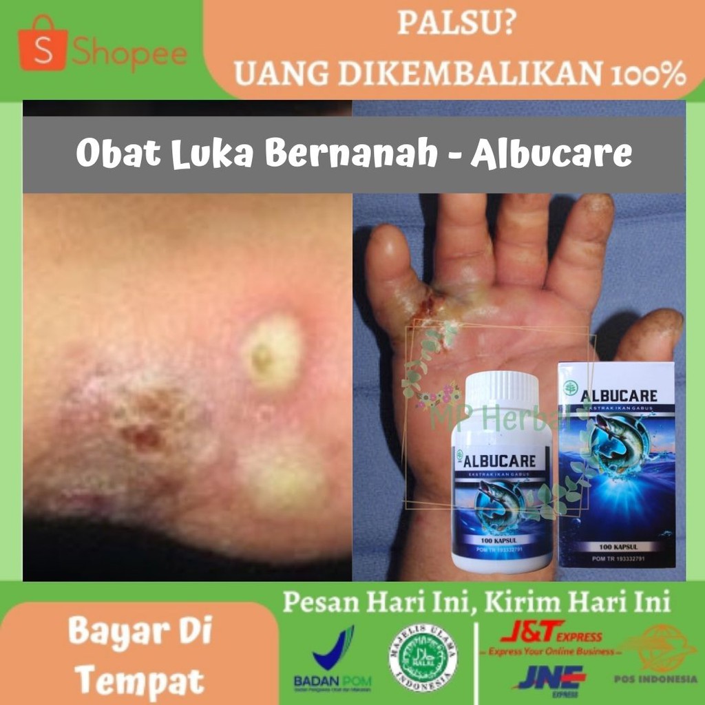 Jual Obat Luka Bernanah - Obat Luka Borok - Obat Gatal Bernanah - Obat Borok Bernanah - Albucare Kapsul Indonesia|Shopee Indonesia