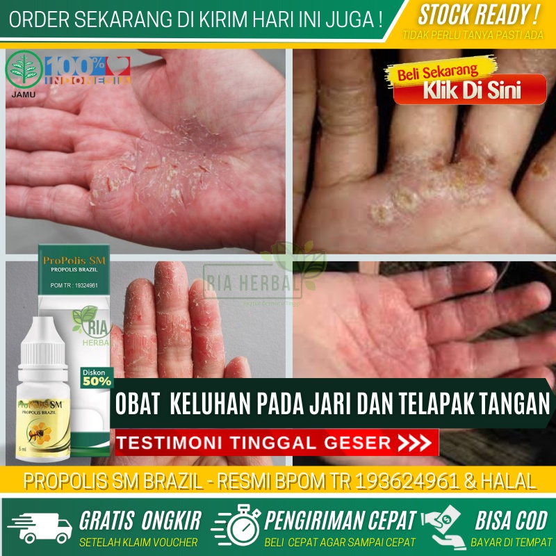 Obat Gatal Kuman Air Untuk Anak, Obat Tetes Kutu Air Di Tangan Yang Sudah Parah, Obat Kutu Air Di Ta