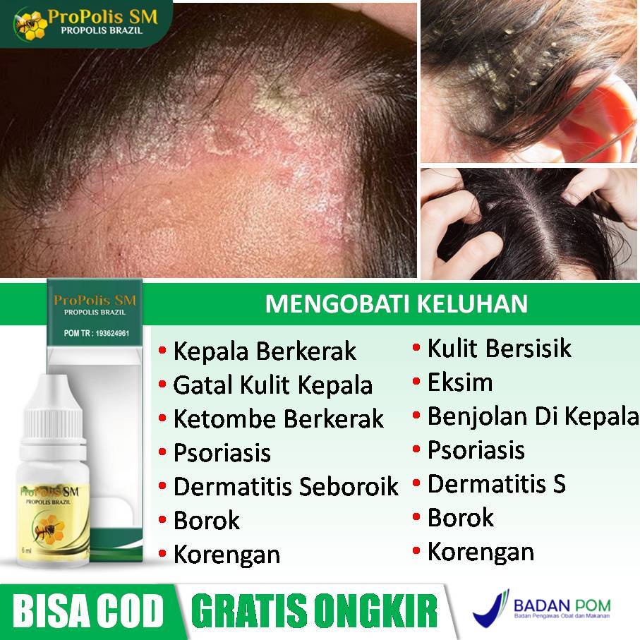 Jual Obat Gatal Kulit Kepala, Kulit Kepala Berkerak, Psoriasis, Ketombe