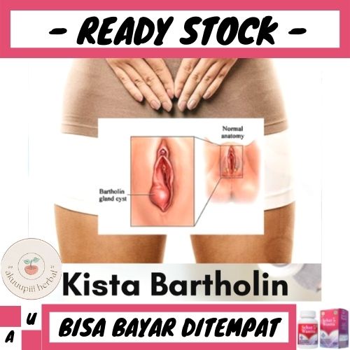 Obat Kista Bartholin, Obat Untuk Kista Bartholin, Obat Kista Bartholini, Obat Benjolan Di Miss V, Ob