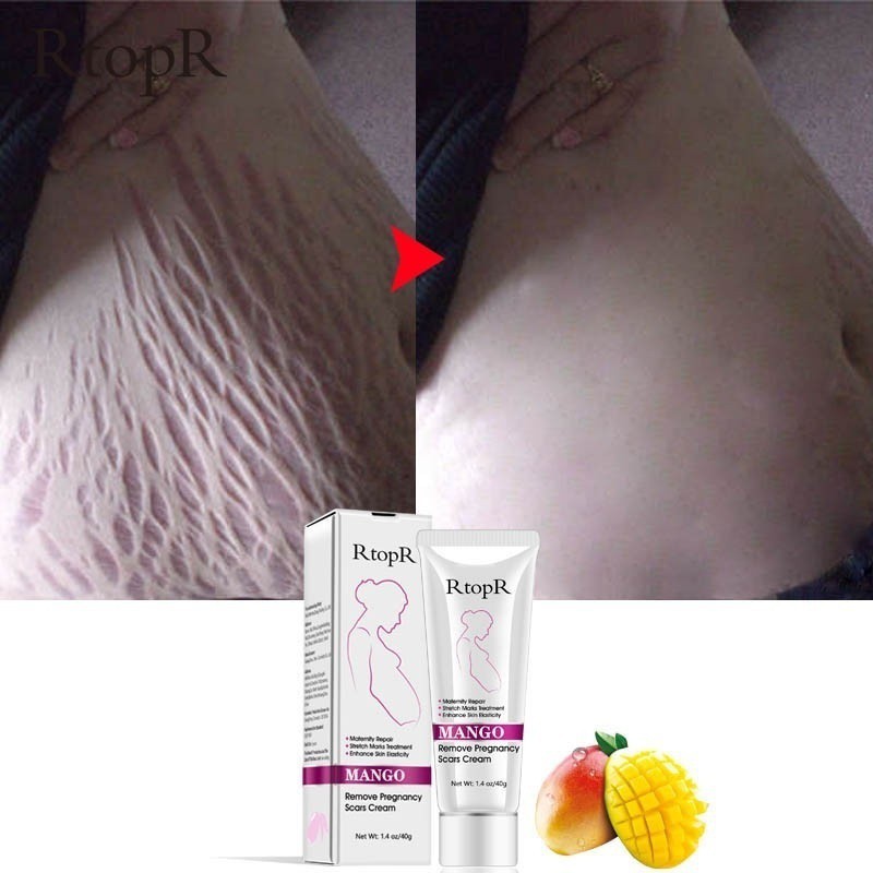 Mark Cream Stretch Mark Untuk Memperbaiki Stretch Mark Ibu Hamil Shopee Indonesia