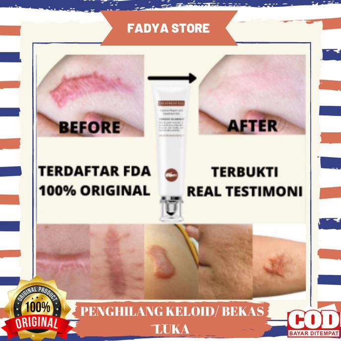 Obat Salep Krim Cream Penghilang Keloid Bekas Luka Bakar Scar Bopeng V
