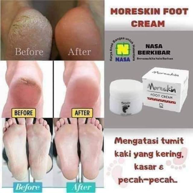 Moreskin Foot Cream Nasa Cfoot Atasi Tumit Kering Kasar Pecah Pecah Shopee Indonesia