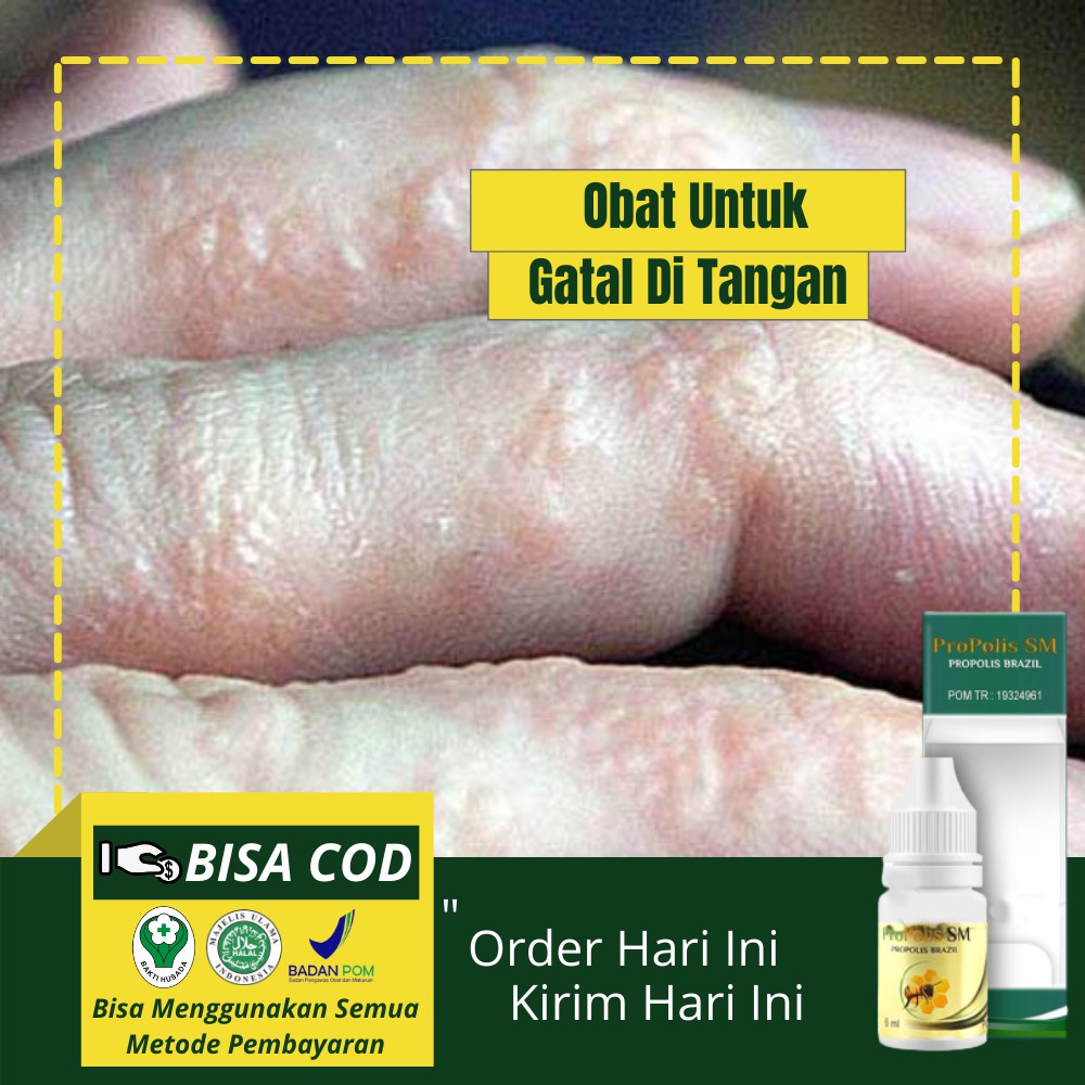 Obat Gatal Pada Jari Tangan Herbal Bintik Air Di Tangan Obat Kulit Gatal Dengan Propolis Sm Shopee Indonesia