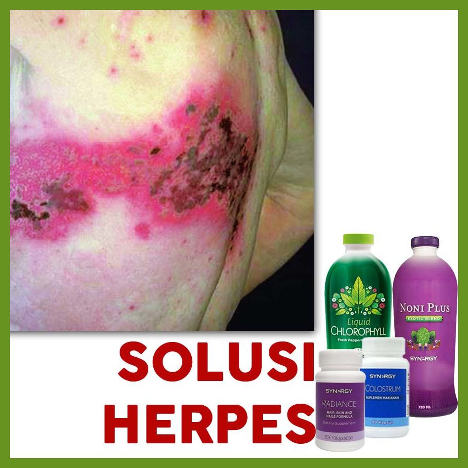 PROMO HERBAL Cacar Api / Cacar Ular / Herpes Paling Dicari