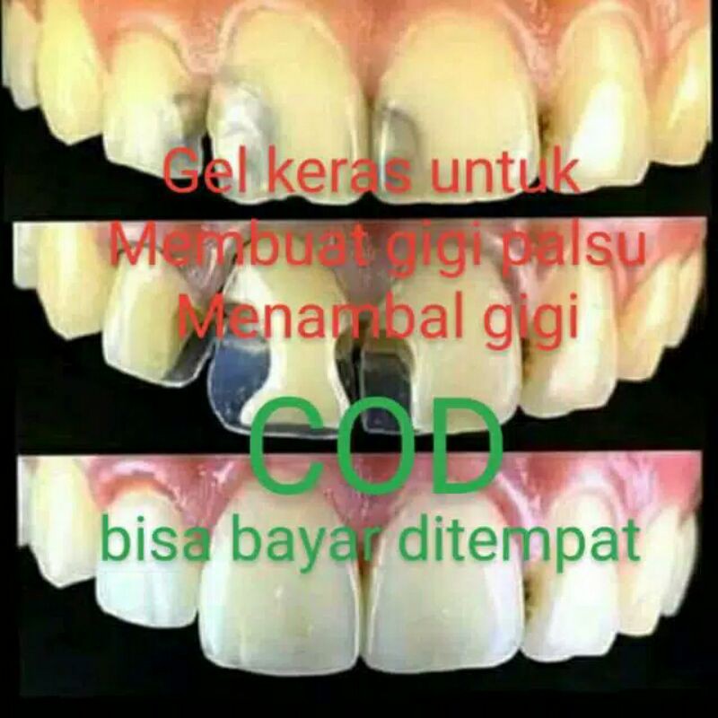 Tempthooth/tambalan gigi sementara