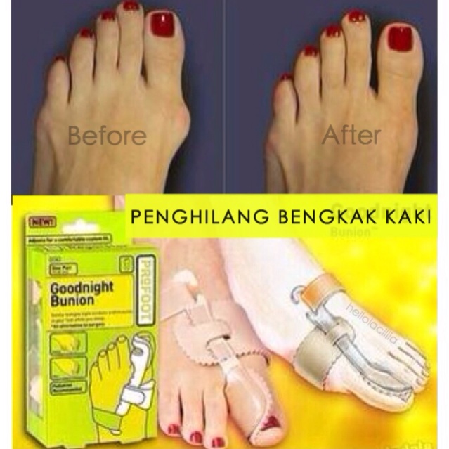 Goodnight Bunion