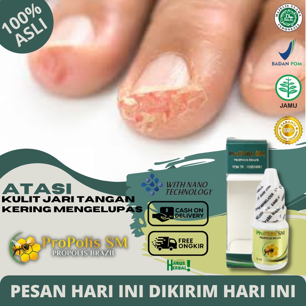 Jual Obat Tetes Kulit Jari Mengelupas Obat Oles Jari Tangan Kering