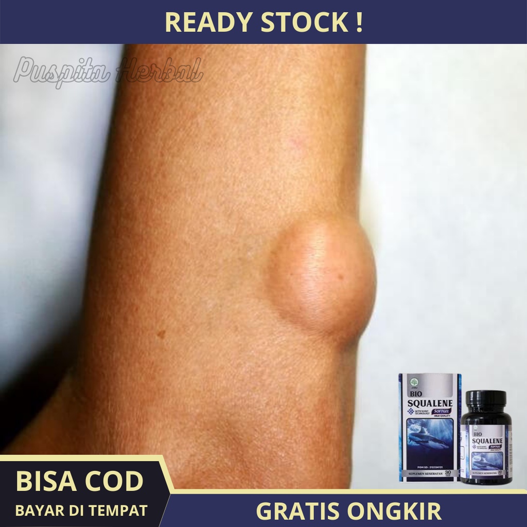 Obat Benjolan Lipoma - Obat Penghancur Benjolan Lipoma, Obat Penghilang Benjolan Lipoma, Obat Pengem