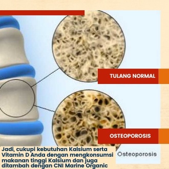 Marine Organic Calcium Mineral Alami Mencegah Osteoporosis Dan Membentuk Tulang Anda Lebih Padat