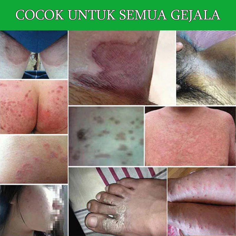 Salep Gatal Obat Gatal 30g Obat Gatal Selangkangan Salep Gatal Paling Ampuh Psoriasis/Tangan/ Kaki/Bau/Belang/ Dermatitis Jamur/Krim Antipruritus