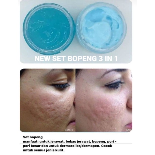 NEW PAKET BOPENG 3 IN 1 || SKINCARE BOPENG ACNE PRIORITY