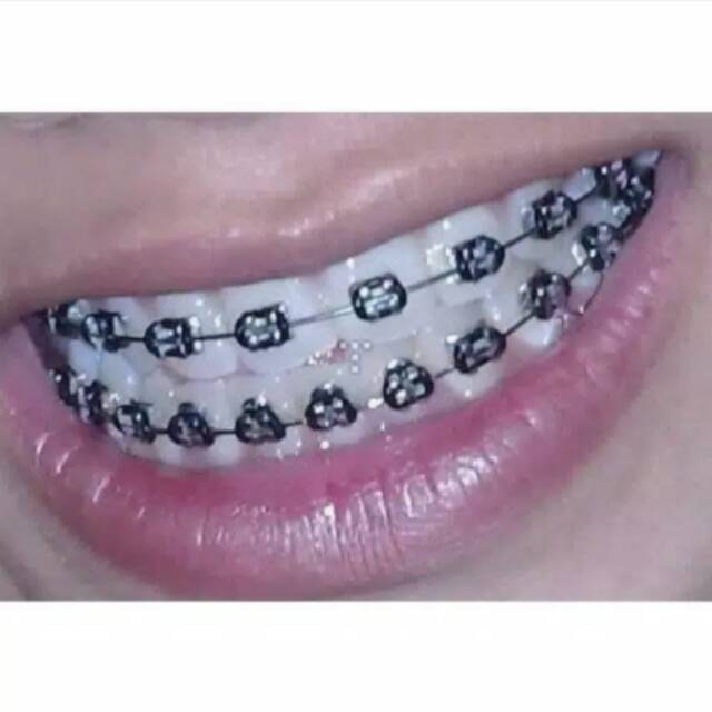 Behel lepas pasang