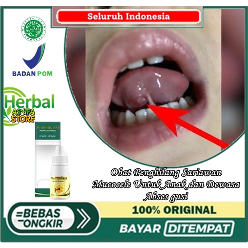 Obat Penghilang Sariawan, Mucocele Untuk Anak dan Dewasa, Abses gusi, Sariawan parah, Minuman untuk 