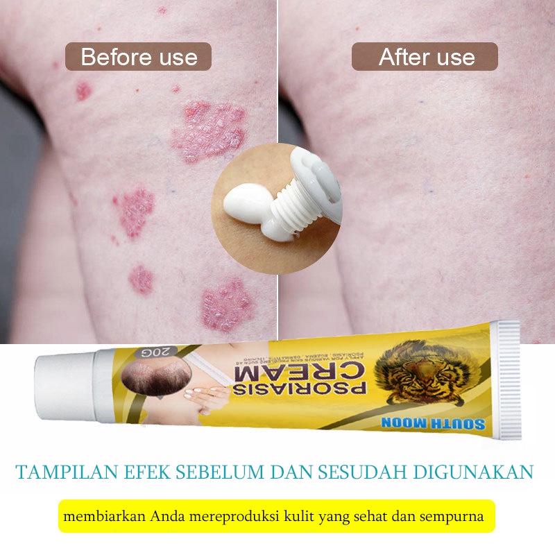 Salep Gatal Obat Gatal Kulit 20g Kulit Kepala Psoriasis Tangan Tinea Kaki Bau Versicolor Menghambat Dermatitis Jamur Salep Gatal Paling Ampuh