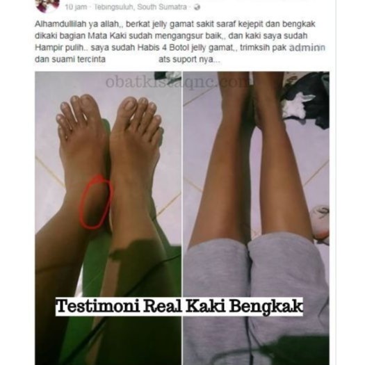 Obat Herbal Kaki Bengkak Berlubang Bernanah Berkeringat Qnc Jelly Gamat Shopee Indonesia