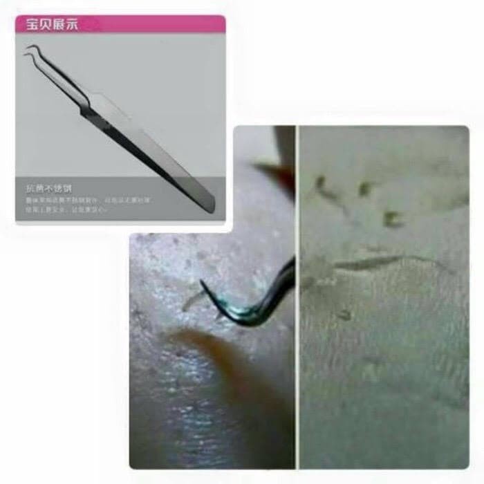 Alat Pencet Komedo / Pinset Pembersih Blackhead / Penjepit Komedo Acne