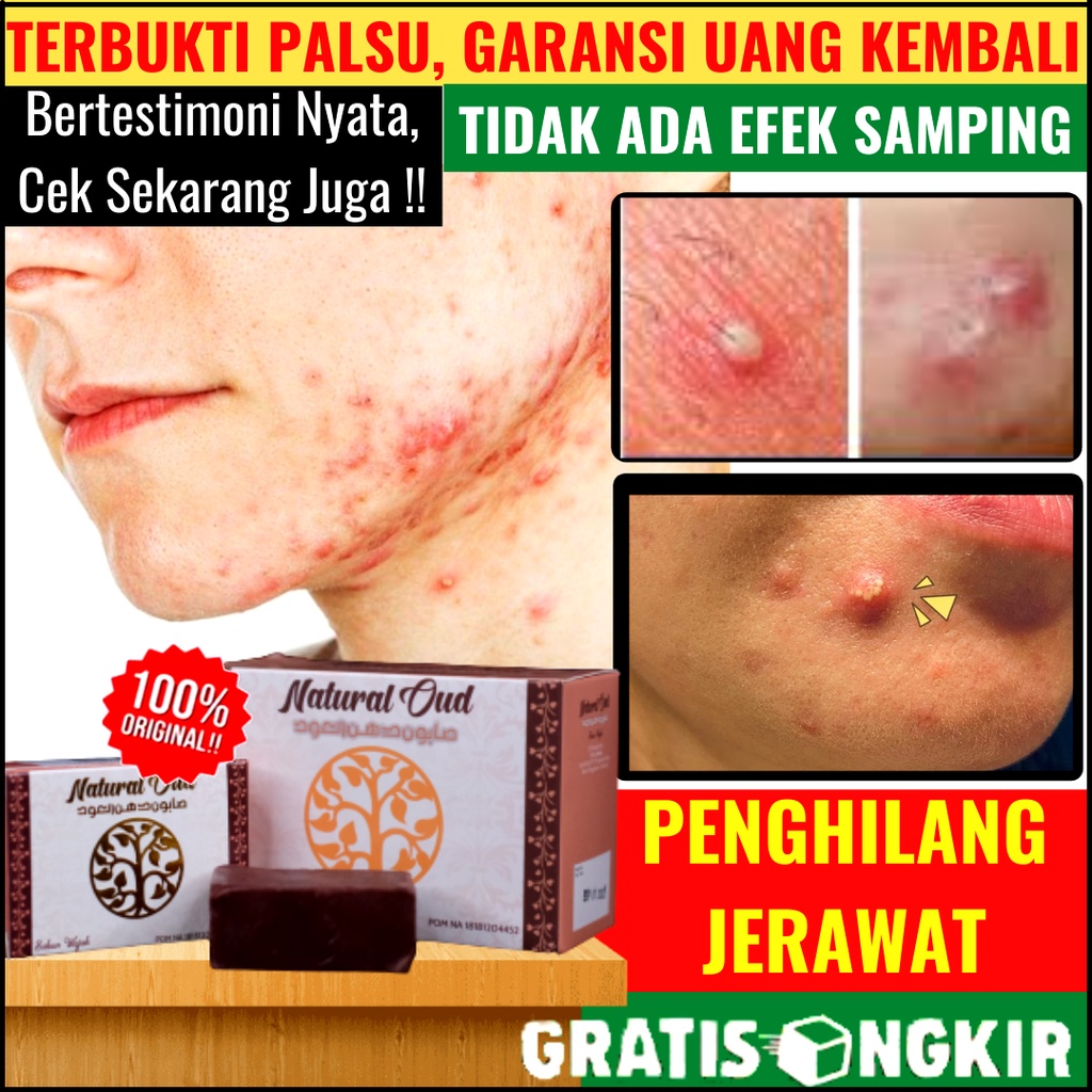Sabun Wajah Sabun Muka Jerawat Obat Penghilang Jerawat Pria & Wanita Sabun Cuci Muka Jerawat Sabun N